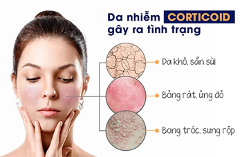 Da nhiễm CORTICOID có chữa được không?